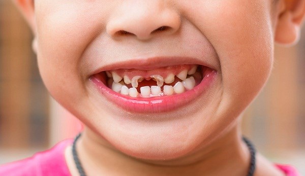 Cảnh báo 7 loại thực phẩm gây sâu răng